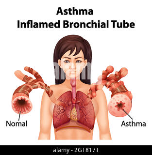 Asthma inflamed bronchial tube Stock Vector