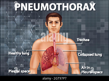 Informative illustration of Pneumothorax Stock Vector