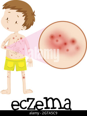 Human Medical Education of Eczema illustration Stock Vector Image & Art ...