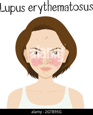 A Vector of Lupus Erythematosus illustration Stock Vector Image & Art ...