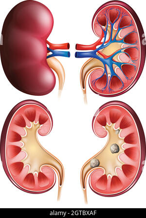 Kidneys and kidney stones on poster Stock Vector