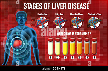 Stages of liver disease Stock Vector