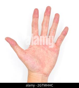 Cyanotic hands or peripheral cyanosis or blue hands at Southeast Asian, Chinese male patient with congenital heart disease. Stock Photo