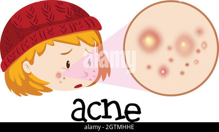 A Teenage Having Acne on Face Stock Vector
