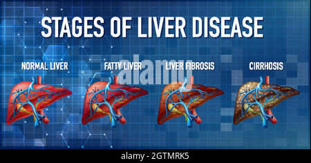 Stages of liver disease leading to Cirrhosis illustration Stock Vector ...