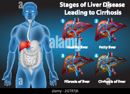 Stages of liver disease Stock Vector