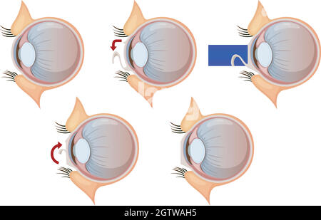 Laser eye correction Stock Vector