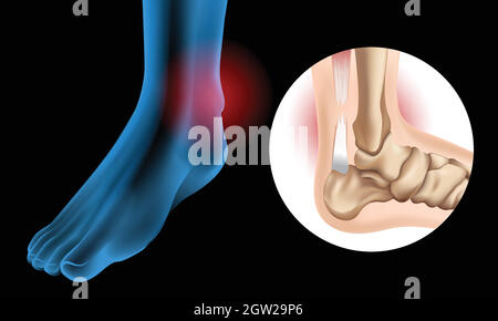Diagram showing Chronic Achilles tendon tear Stock Vector