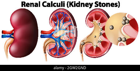 Anatomy of kidney and kidney stones Stock Vector