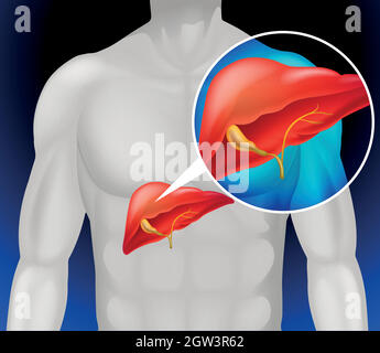 Liver cancer diagram in detail Stock Vector
