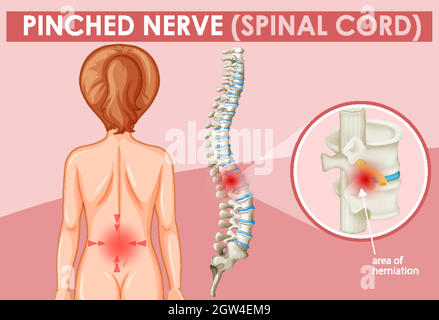 Diagram showing pinched nerve in human Stock Vector