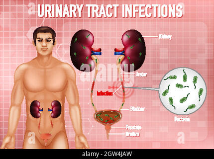 Informative illustration of urinary tract infections Stock Vector