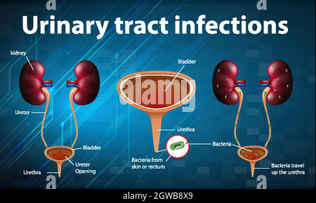 Informative illustration of urinary tract infections Stock Vector