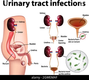 Informative illustration of urinary tract infections Stock Vector