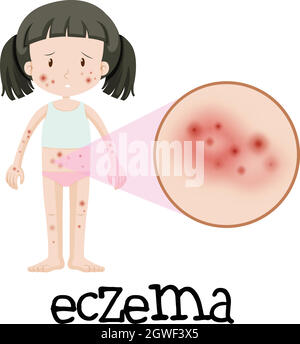 A Girl with Eczema on White Background illustration Stock Vector Image ...