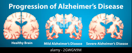 Progression of Alzheimer's disease on blue background Stock Vector