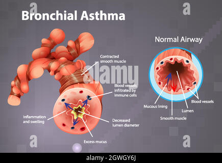 Asthma inflamed bronchial tube Stock Vector