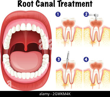 Dental Vector of Root Canal Treatment Stock Vector