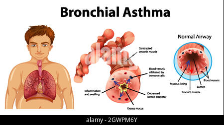 Asthma inflamed bronchial tube Stock Vector