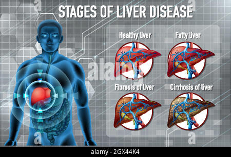 Stages of liver disease Stock Vector