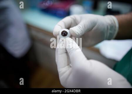 Kathmandu, Nepal. 4th Oct, 2021. Kumar Shrestha, an ocularist holds an artificial eye to implant on a two-year-old boy (name undisclosed) after his left eye was removed in a surgery affected by retina cancer at Tilganga Eye hospital in Kathmandu, Nepal on Monday, October 4, 2021. (Credit Image: © Skanda Gautam/ZUMA Press Wire) Stock Photo