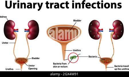 Informative illustration of urinary tract infections Stock Vector