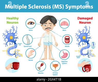 Multiple sclerosis (MS) symptoms information infographic Stock Vector