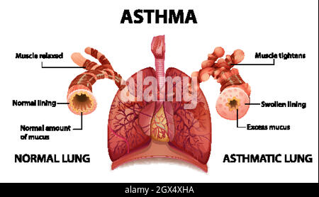 Asthma diagram with normal lung and asthmatic lung illustration Stock ...