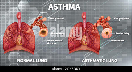 Asthma diagram with normal lung and asthmatic lung illustration Stock ...