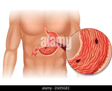 Stomach Ulcer in human body Stock Vector