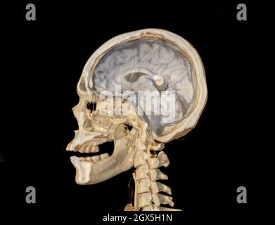 A Haft of the skull 3D showing the brain . Stock Photo