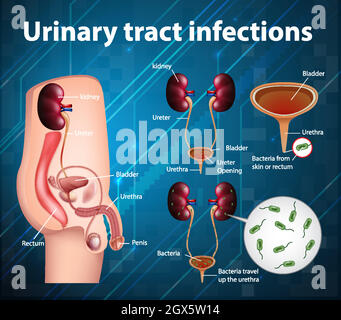 Informative illustration of urinary tract infections Stock Vector