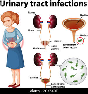 Informative illustration of urinary tract infections Stock Vector