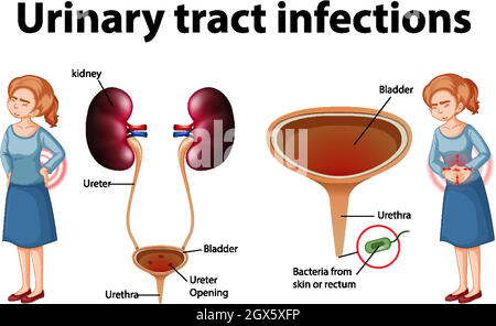 Informative Illustration Of Urinary Tract Infections Illustration Stock ...