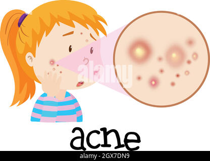 A Young Woman Having Acne Stock Vector