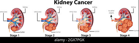 Diagram showing different stages of kidney cancer Stock Vector
