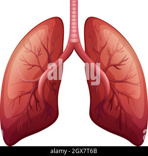 Diagram of lung cancer illustration Stock Vector Image & Art - Alamy