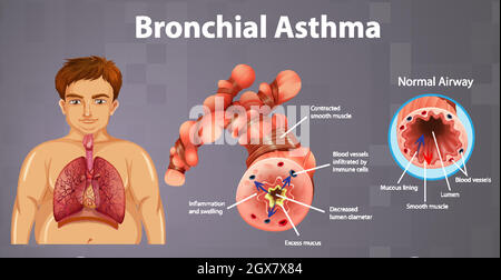 Asthma inflamed bronchial tube Stock Vector