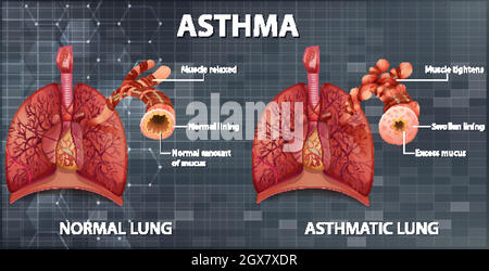 Comparison of healthy lung and Asthmatic lung Stock Vector Image & Art ...