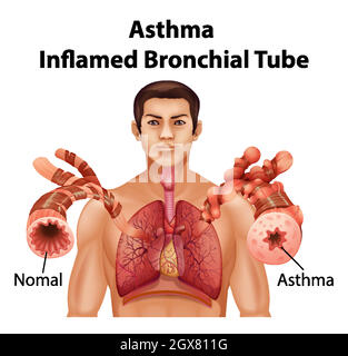 Human anatomy Asthma Inflamed Bronchial Tube diagram Stock Vector