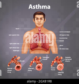 Human anatomy Asthma diagram Stock Vector