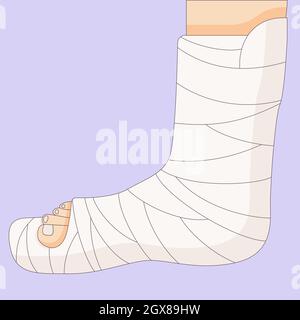Broken leg in a cast bandage, orthopedic gypsum, injury bone, vector illustration drawn in a flat style. Stock Vector