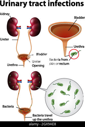 Informative illustration of urinary tract infections Stock Vector