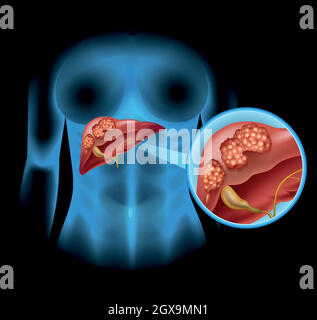 Liver Cancer diagram in detail Stock Vector