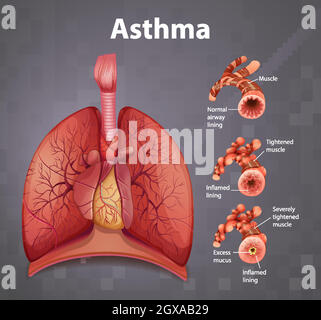 Asthma diagram with normal lung and asthmatic lung illustration Stock ...