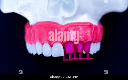 Teeth implant and crown installation process isolated on a blue background. Medically accurate 3D illustration Stock Photo