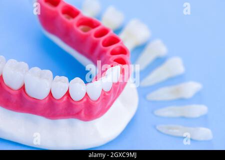 Teeth implant and crown installation process isolated on a blue background. Medically accurate 3D illustration Stock Photo