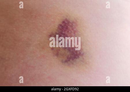 Large bruise on the human body, close up Stock Photo