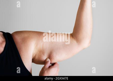 Older Woman Cosmetic Liposuction Surgery And Body Fat Check Stock Photo