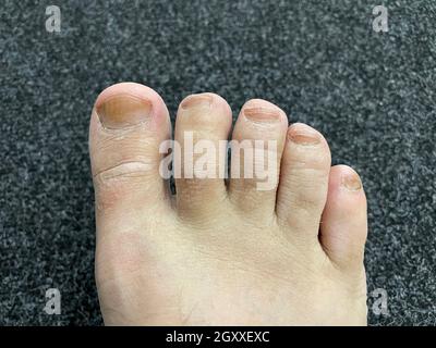 Fungus-damaged nails on the right male leg Stock Photo